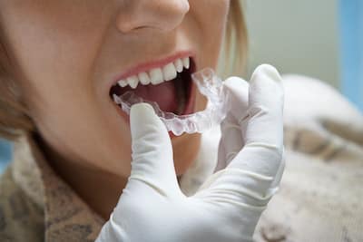 Zahnzusatzversicherung Kieferorthopädie für Erwchsene und Kinder